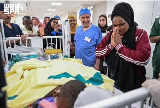 نجاح عملية فصل التوأم الملتصق التنزاني بعد 14 ساعة ونصف